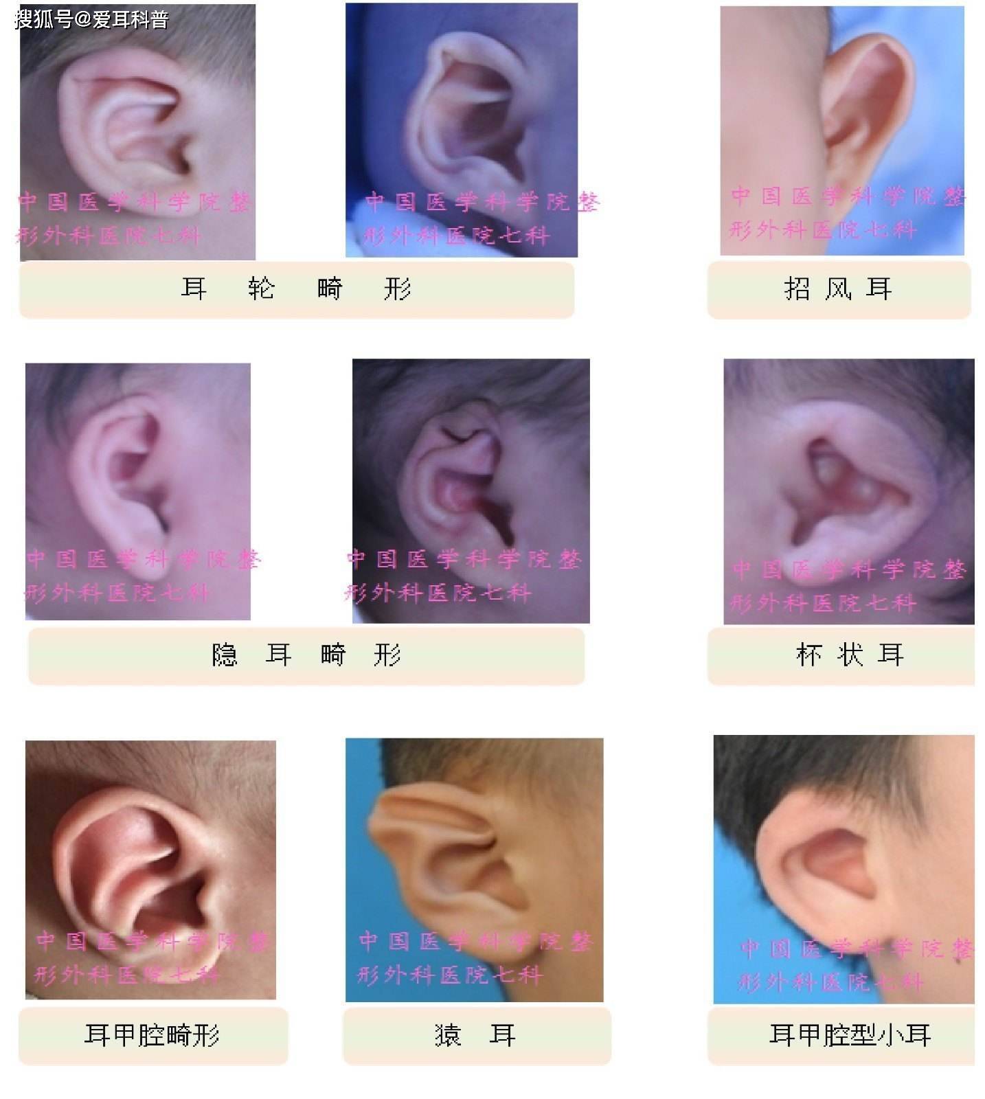 婴儿耳朵畸形有哪几种类型