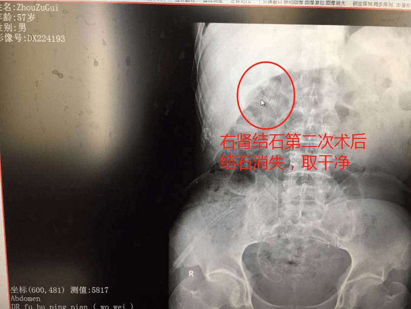 突发腰痛别小视!湖北大叔突感腰痛经查巨大肾结石致肾功能受损