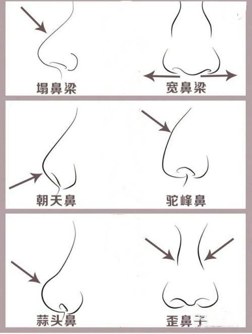 常见的鼻子问题有以下几种