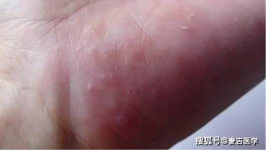 注意和这些疾病区分1,水疱型手足癣水疱型手足癣是一种临床极为常见的