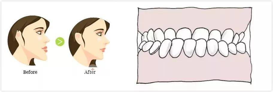 这些牙齿不齐问题在孩子12岁前必须要矫正!