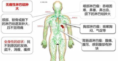 怎么正确区分淋巴瘤和淋巴癌?成都中医肿瘤医院段心好