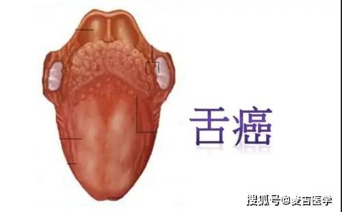 女子做核酸检测发现得了舌癌!身体4个症状提示,或是舌癌信号