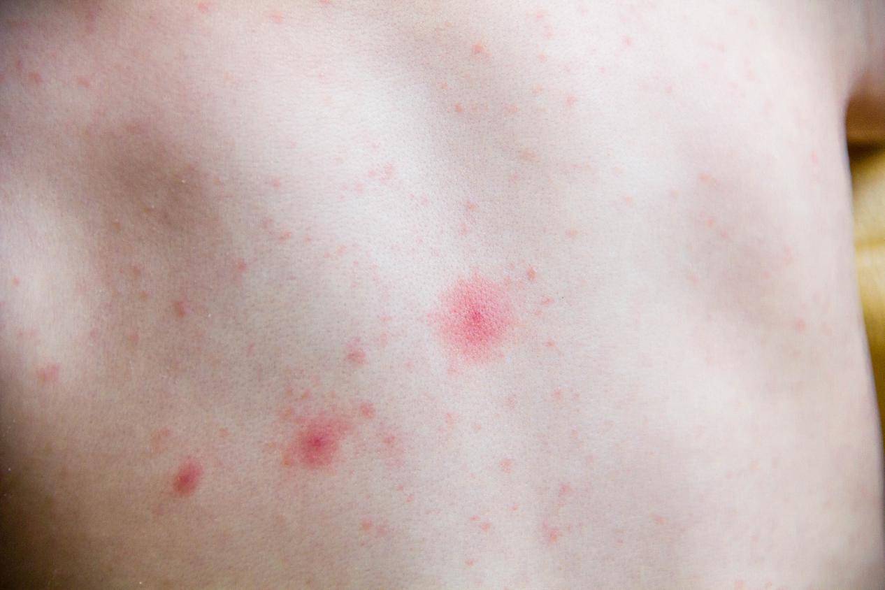 长春肤康医院浅谈:秋季来临小心荨麻疹,荨麻疹发病和这些因素有关