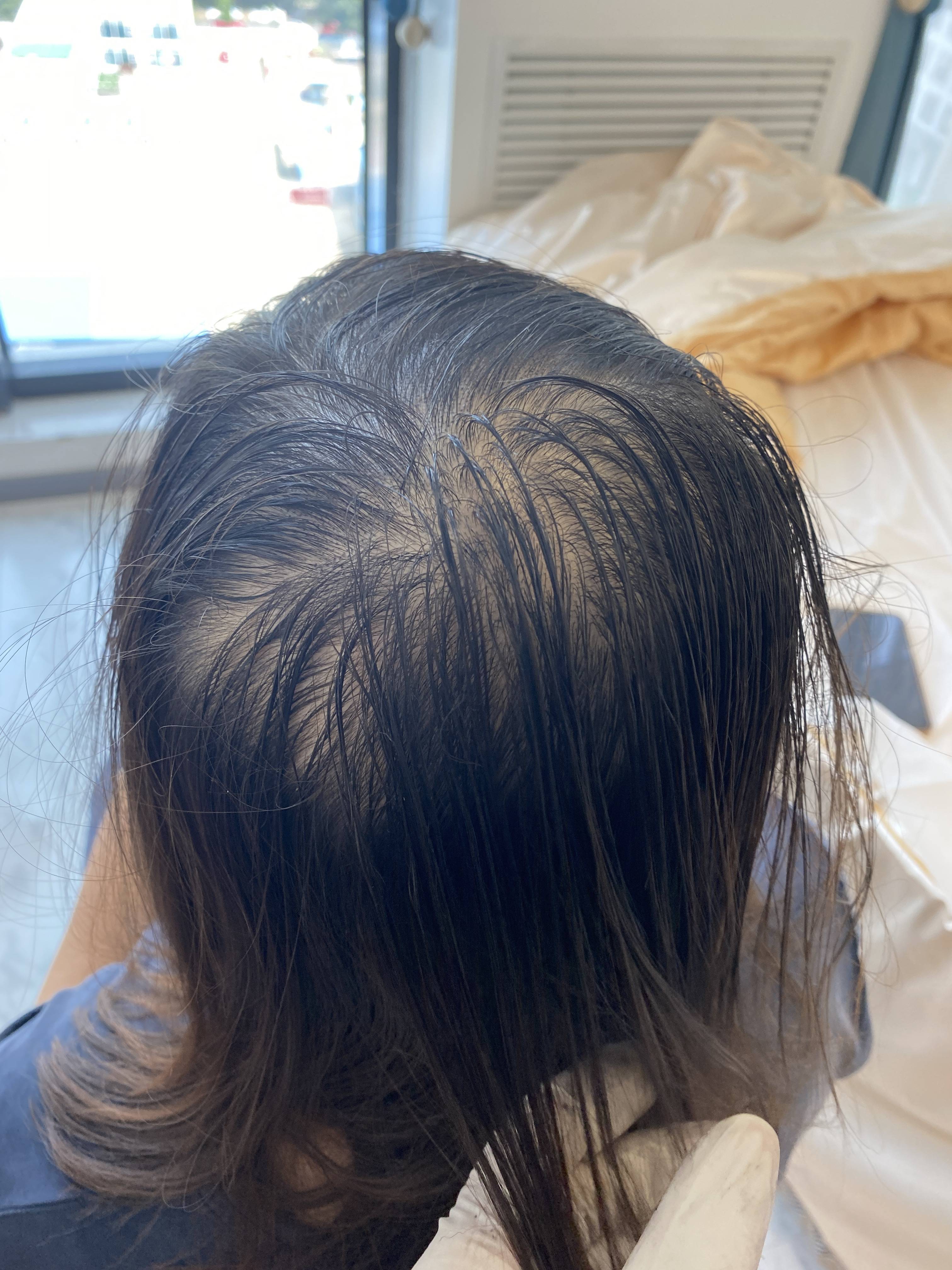 1 12 头顶头发稀疏,这种情况可以采用纹发里的加密方案来做掩饰,在