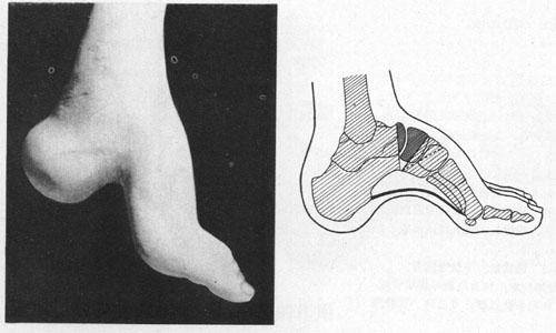 跖骨基底,楔骨和舟骨等中足部背侧骨性隆起,有的还有爪形趾畸形,后足