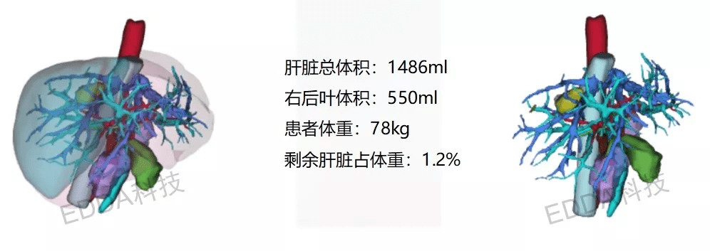 上海东方肝胆医院手术直播周,精准手术规划助力周伟平教授团队7台手术