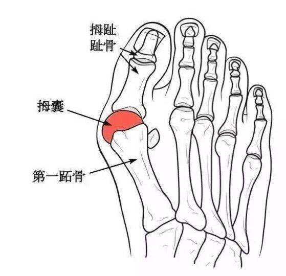 拇僵硬在生活中较为多见,患者拇趾的第一跖趾关节部位,明显向外侧进行