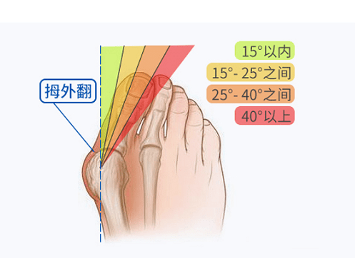 肖占海:如何判断自己有没有拇外翻_畸形_患者_治疗