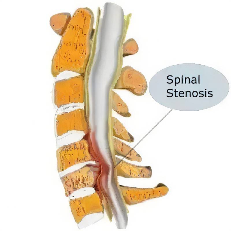 椎管狭窄spinal stenosis-顺德康复_脊柱_神经_脊髓