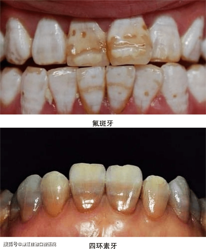 第一是指牙齿表面的残留污渍,通常是由饮料,食物,烟草和牙菌斑等因素