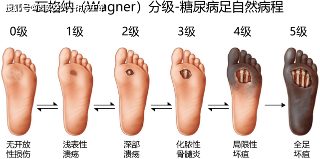 糖尿病患者如何护理足部糖足的临床症状不要大意