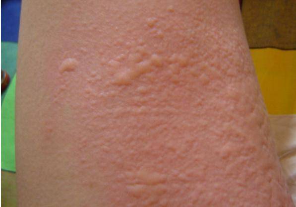 荨麻疹皮肤痒起疙瘩,好了又复发?防治如何做?