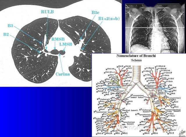 推荐| ct支气管解剖