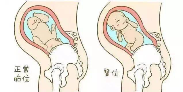 正常胎位与臀位的示意图