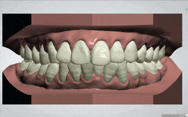 深扒牙齿矫正内幕只要1万多的隐形牙套在家也能完成矫正