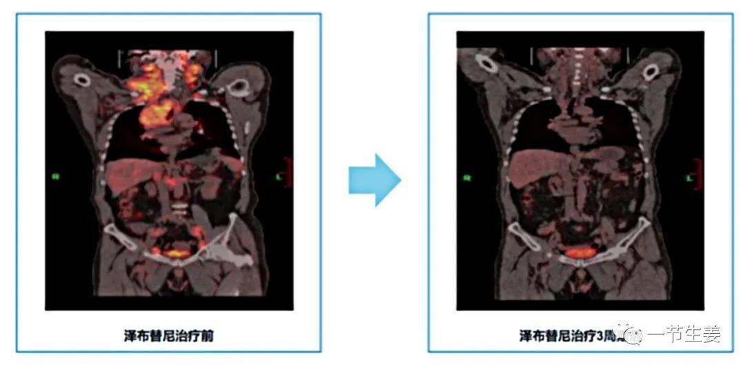 新药正式在中国获批了第一款获得国际认可的本土抗癌新药