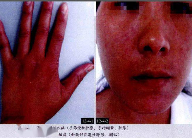 性血管炎67鱼鳞病68毛发角化病69汗孔角化症70掌跖角化病71原发性皮肤