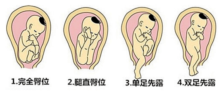 臀位一般建议剖腹产,只有在万不得已的情况下才考虑阴道分娩.