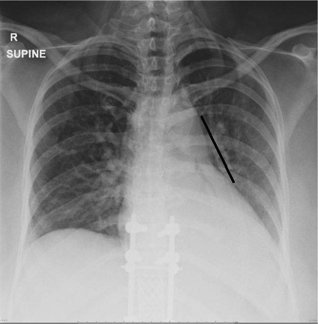 b图:右肺中叶不张,伴支气管扩张. (4)左,右肺下叶不张