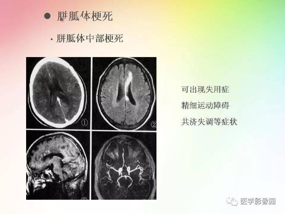 胼胝体病变的影像表现