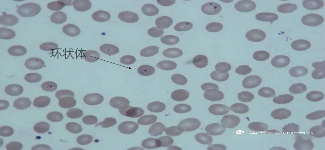 图片讨论顾剑飞老师:在涂片镜检时,发现有白细胞吞噬裂殖体的现象