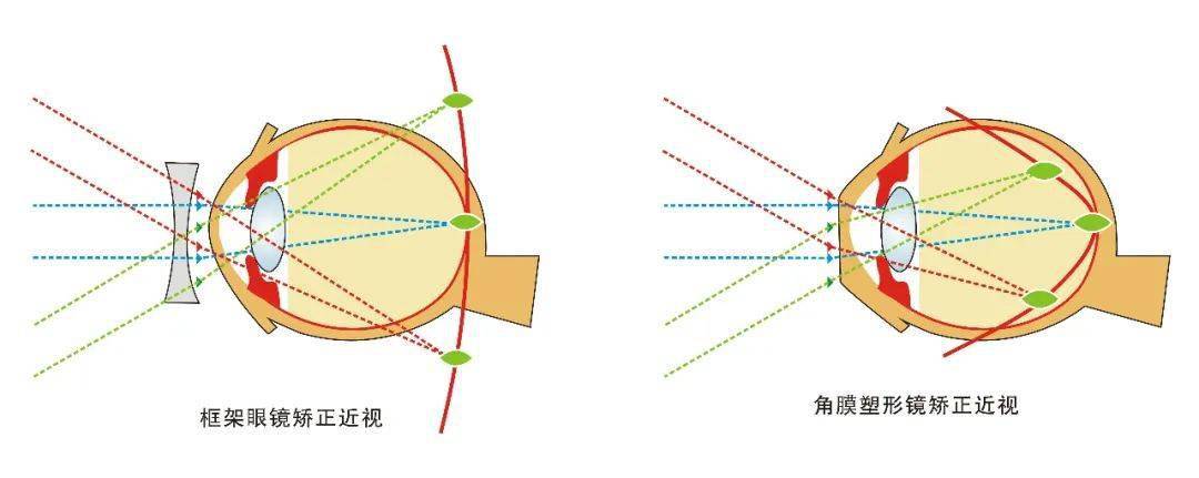 医生,孩子近视了,能不能不戴眼镜?_角膜