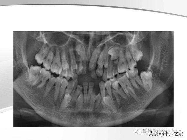 牙及牙周各种疾病影像学表现整理