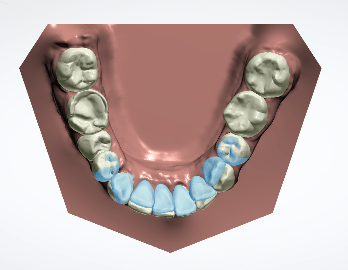 3张牙齿照片就能获得牙齿矫正方案,1w多的牙套在家完成矫正?
