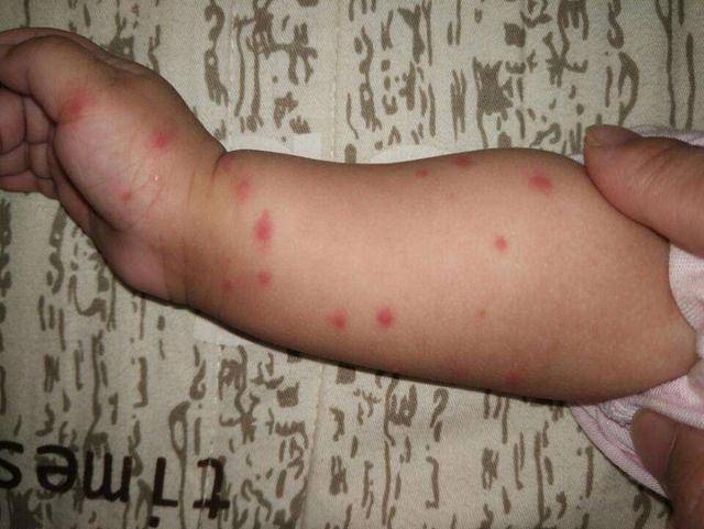 2岁宝宝被蚊子叮咬后住院  这两天新闻报道说襄阳有一个2岁男孩淘淘
