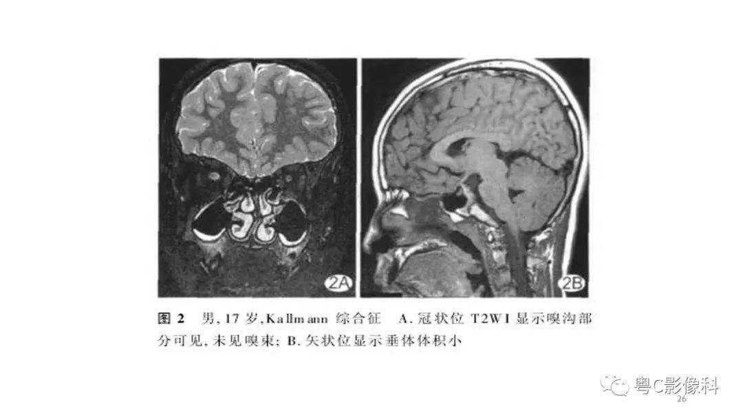 垂体的正常mr表现及儿童垂体缩小病变的mr表现