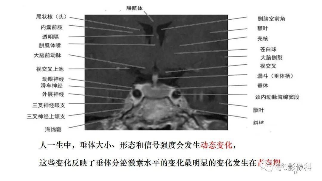 垂体的正常mr表现及儿童垂体缩小病变的mr表现