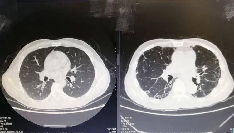 左为正常的肺部ct右为特发性肺纤维化的肺部ct考虑到特发性肺纤维化