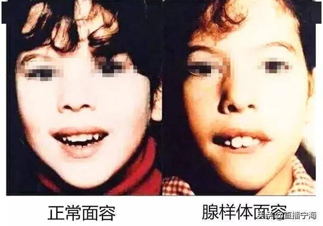 孩子睡觉打呼噜,张口呼吸?警惕腺样体肥大