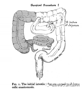 代谢外科开山鼻祖---空肠回肠旁路术