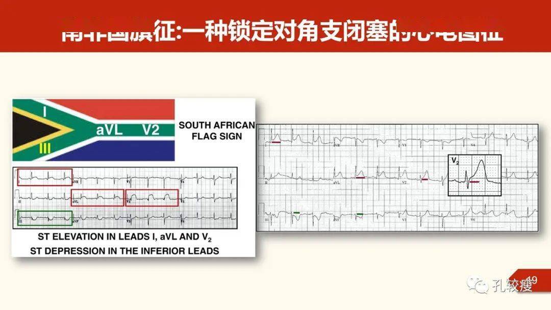 南非国旗征一种判断对角支闭塞的心电图表现