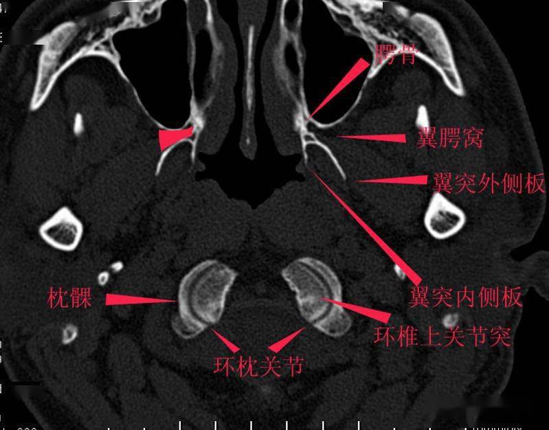 详细标注的颅底解剖