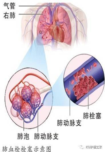 什么原因导致肺栓塞 f56c2c78b2104b7e875a8e0a91cb4665.jpeg