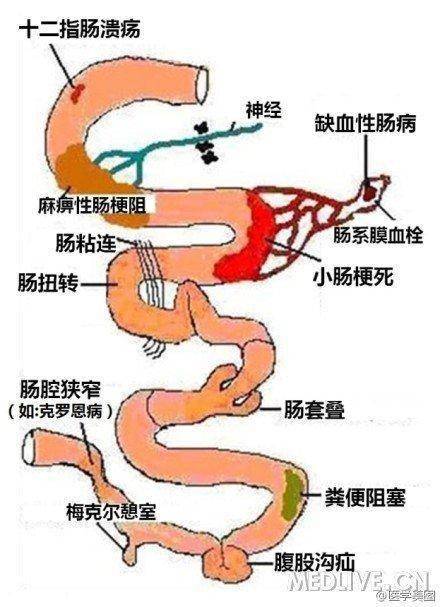 小肠出血与非特异性小肠溃疡