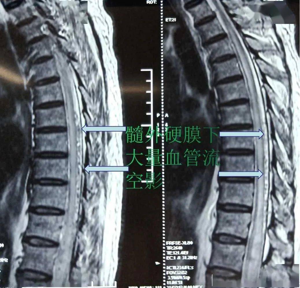 【正海-妙术视界】陈来照主任团队:硬脊膜动静脉瘘一例