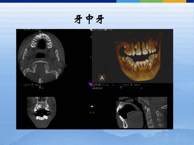 牙体牙周正常解剖及常见病x线表现