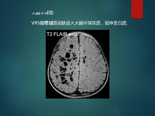 脱髓鞘疾病,腔隙性脑梗死与血管周围间隙的鉴别诊断