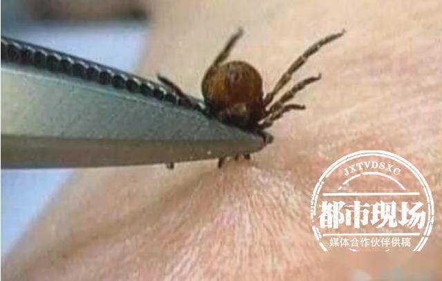 怪异!男子扫墓归来 肚子上出现奇异黑斑