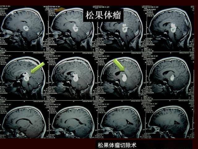 巨大松果体瘤切除术