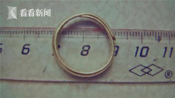 1岁女童哭闹不止医生从胃里取出直径2cm金戒指