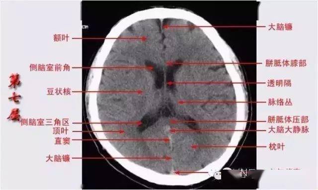 颅脑ct解剖口诀及彩色解剖图