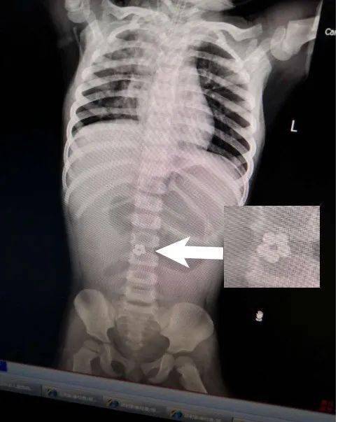 巴克|2岁娃因它进了ICU【警惕】家长注意！这种网红玩具千万别买