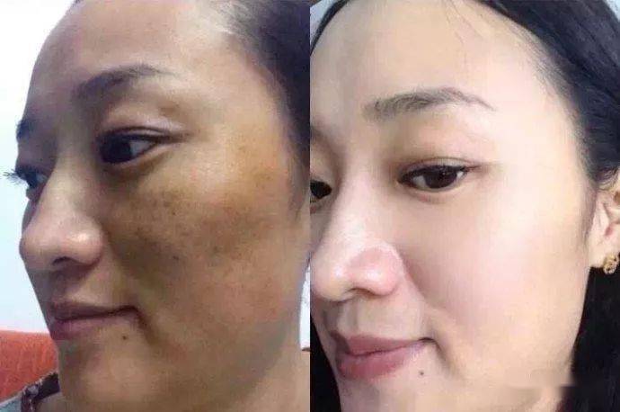 其实祛斑很简单，斑点的产生就是黑色素沉淀形成的，这些沉淀物慢慢的就