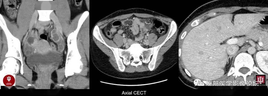 history: young adult, right flank pain.
