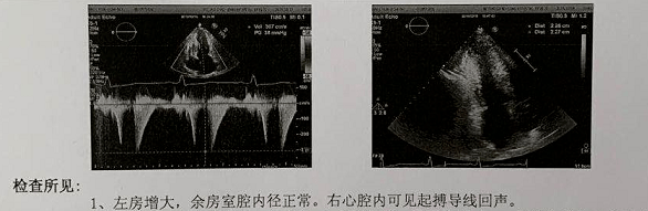 图:检查:超声心动图左心房的大小对房颤患者的预后很重要,且心房越大